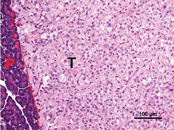 Microscopic image of a kidney tumor growing in the pancreas of a mouse